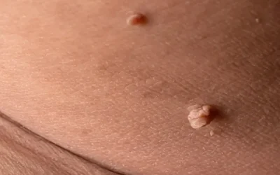 Genital Siğil